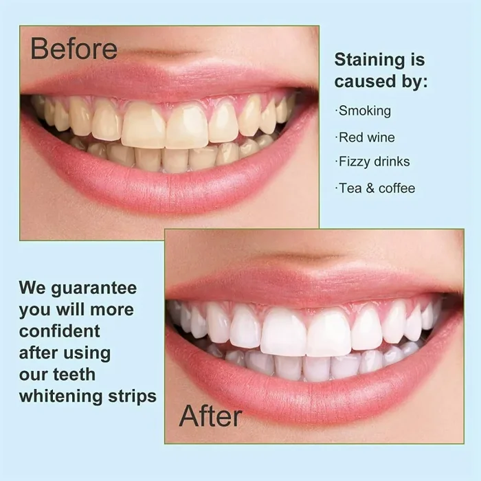 28 x Strisce sbiancanti per rimozione macchie per denti, Strisce Sbiancamento - immagine 2